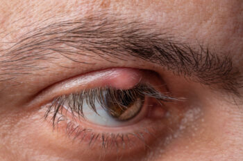 red bump on the upper eyelid
