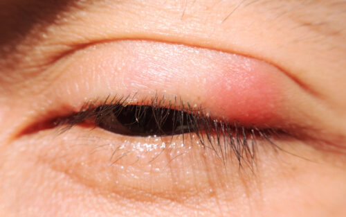 close up Blepharitis or Eyelid inflammation eyes healthy concept