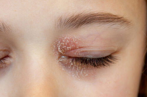 Closed eye of a little girl suffering from ocular atopic dermatitis or eyelid eczema. Eyelid dermatitis