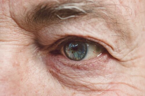 Close-up of the eye of an old person having AMD