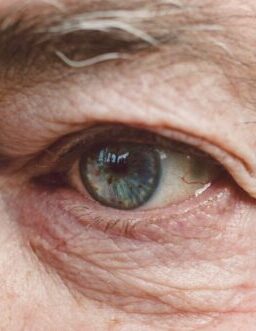 Close-up of the eye of an old person having AMD